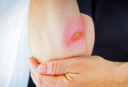 علائم و دلایل سوختگی